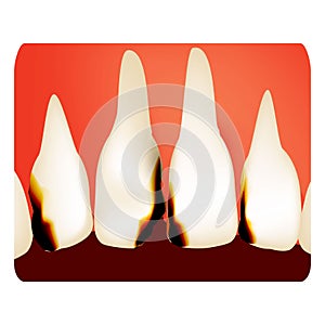 Dental caries. tooth decay. Caries infographics. Vector illustration on isolated background.