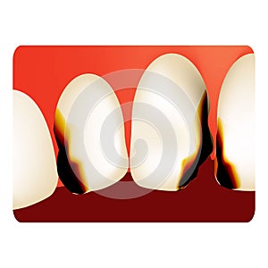 Dental caries. tooth decay. Caries infographics. Vector illustration on isolated background.