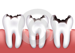 Dental caries photo