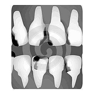 Dental caries. X-ray of tooth decay. Caries infographics. Vector illustration on isolated background.