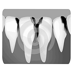 Dental caries. X-ray of tooth decay. Caries infographics. Vector illustration on isolated background.