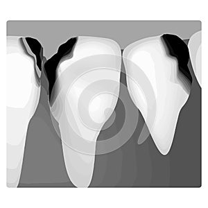 Dental caries. X-ray of tooth decay. Caries infographics. Vector illustration on isolated background.