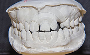 Dental cast