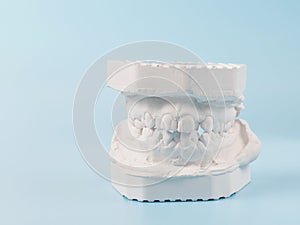 Dental casting gypsum model of human jaws. Crooked teeth and distal bite. Shots were made before treatment with braces . Technical photo
