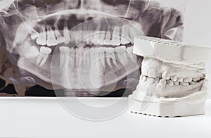 Dental casting gypsum model of human jaws with panoramic dental x-ray . Crooked teeth and distal bite. Shots were made before