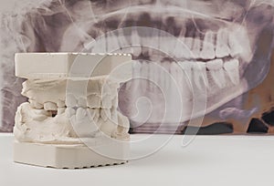 Dental casting gypsum model of human jaws with panoramic dental x-ray . Crooked teeth and distal bite. Shots were made before
