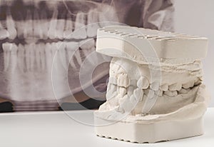 Dental casting gypsum model of human jaws with panoramic dental x-ray . Crooked teeth and distal bite. Shots were made before