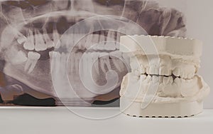 Dental casting gypsum model of human jaws with panoramic dental x-ray . Crooked teeth and distal bite. Shots were made before
