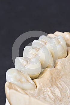 Dental ceramic bridge