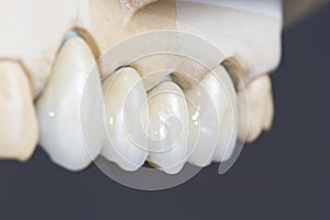 Dental ceramic bridge