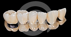 Dental ceramic bridge