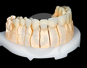 Dental ceramic bridge