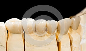 Dental ceramic bridge