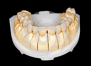 Dental ceramic bridge