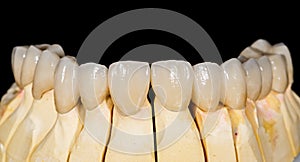 Dental ceramic bridge
