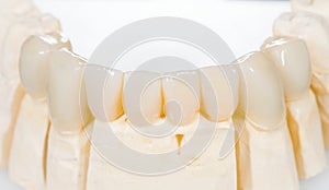 Dental ceramic bridge