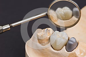 dental ceramic crown