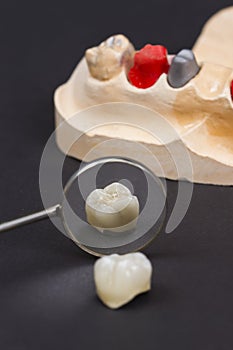 dental ceramic crown