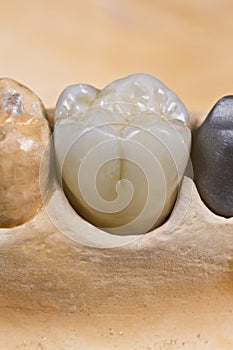 dental ceramic crown