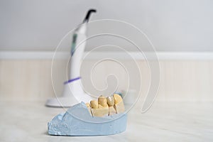 Dental ceramic crown on a plaster model