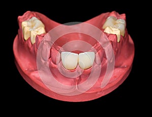 Dental ceramic crowns