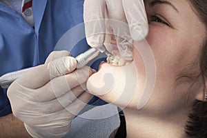 Dental Cleaning Close-up