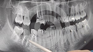 Dental Clinic. The dentist examines a panoramic snapshot of the patient`s teeth.