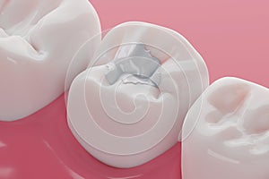 Dental composite white amalgam