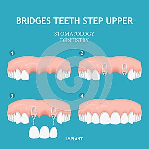 Dental concept. Dentistry and stomatology poster. Single implant.