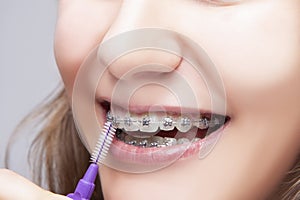 Dental Concepts. Exeteme Closeup Portrait of Teenage Girl Using Bristle Brush for Cleaning Braces and Teeth