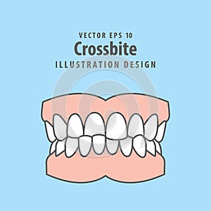 Dental crossbite teeth illustration vector design on blue background. Dental care concept photo
