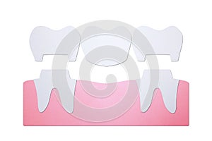 Dental crown with bridge, installation process and change of teeth