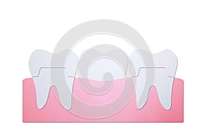 Dental crown with bridge, installation process and change of teeth