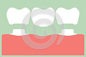 Dental crown with bridge, installation process and change of teeth