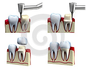 Dental crown installation process photo