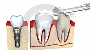 Dental crown installation process