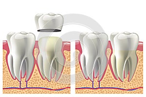 Dental crown installation process. Dental care concept.