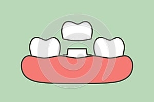 Dental crown, installation process and change of teeth