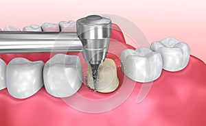 Dental crown installation process