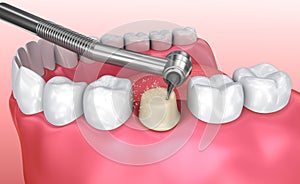 Dental crown installation process