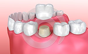Dental crown installation process