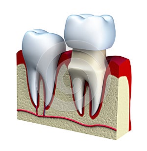 Dental crown installation process, isolated on white