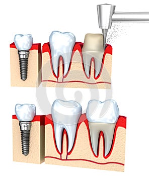 Dental crown installation process, isolated