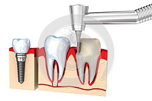 Dental crown installation process