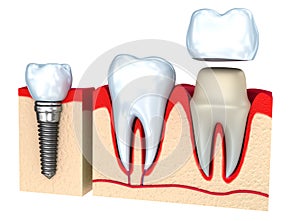 Dental crown installation process