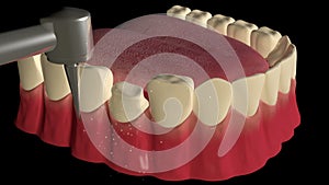 Dental crown procedure