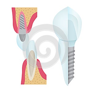 Dental crowns and implantation