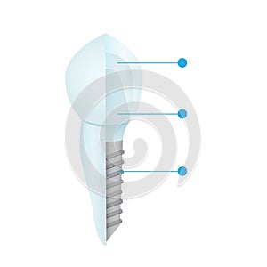 Dental crowns and implantation