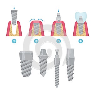 Dental crowns and implantation