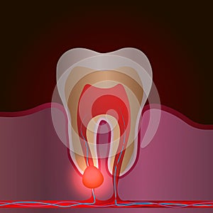 Dental disease with pain and inflammation. Medical illustration of tooth root inflammation, tooth root cyst, pulpitis